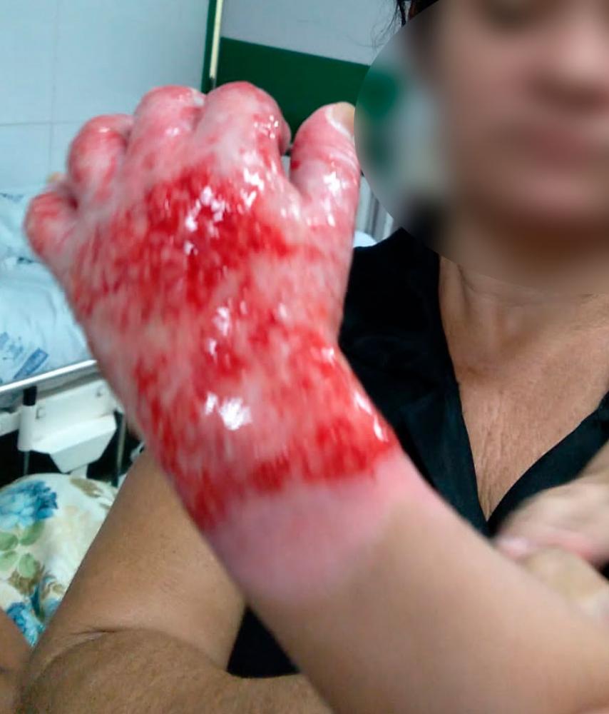 Criança de 02 anos sofre queimadura de 3º grau e família pede ajuda para tratamento, em Pedro II 