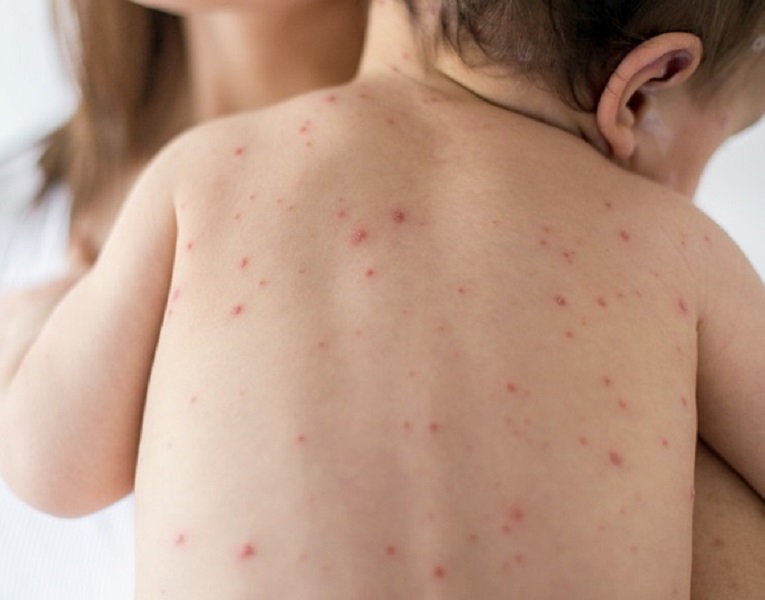Piauí investiga oito casos suspeitos de sarampo, revela Ministério da Saúde