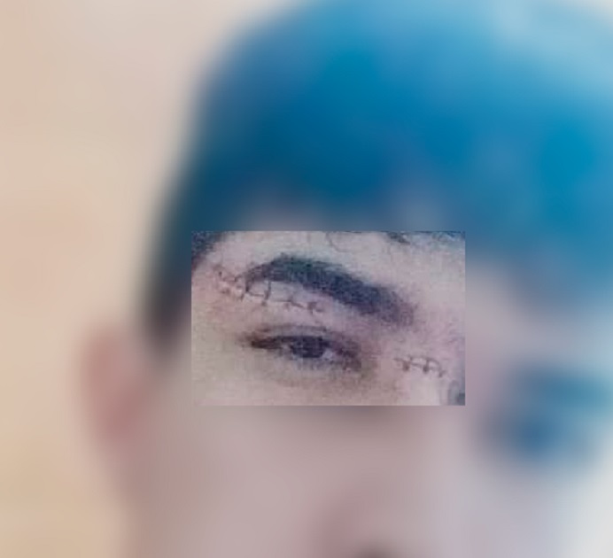 Jovem leva dez pontos no rosto após ser atingido por linha de pipa com cerol, em Pedro II 