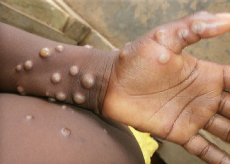 Ministério da Saúde confirma 1ª morte por varíola dos macacos no Brasil