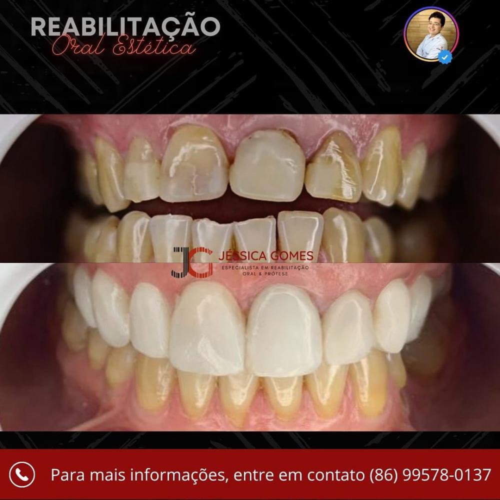 Agende já a sua avaliação e traga o seu sorriso de volta na Clínica Vittalis de Pedro II; confira esse antes e depois
