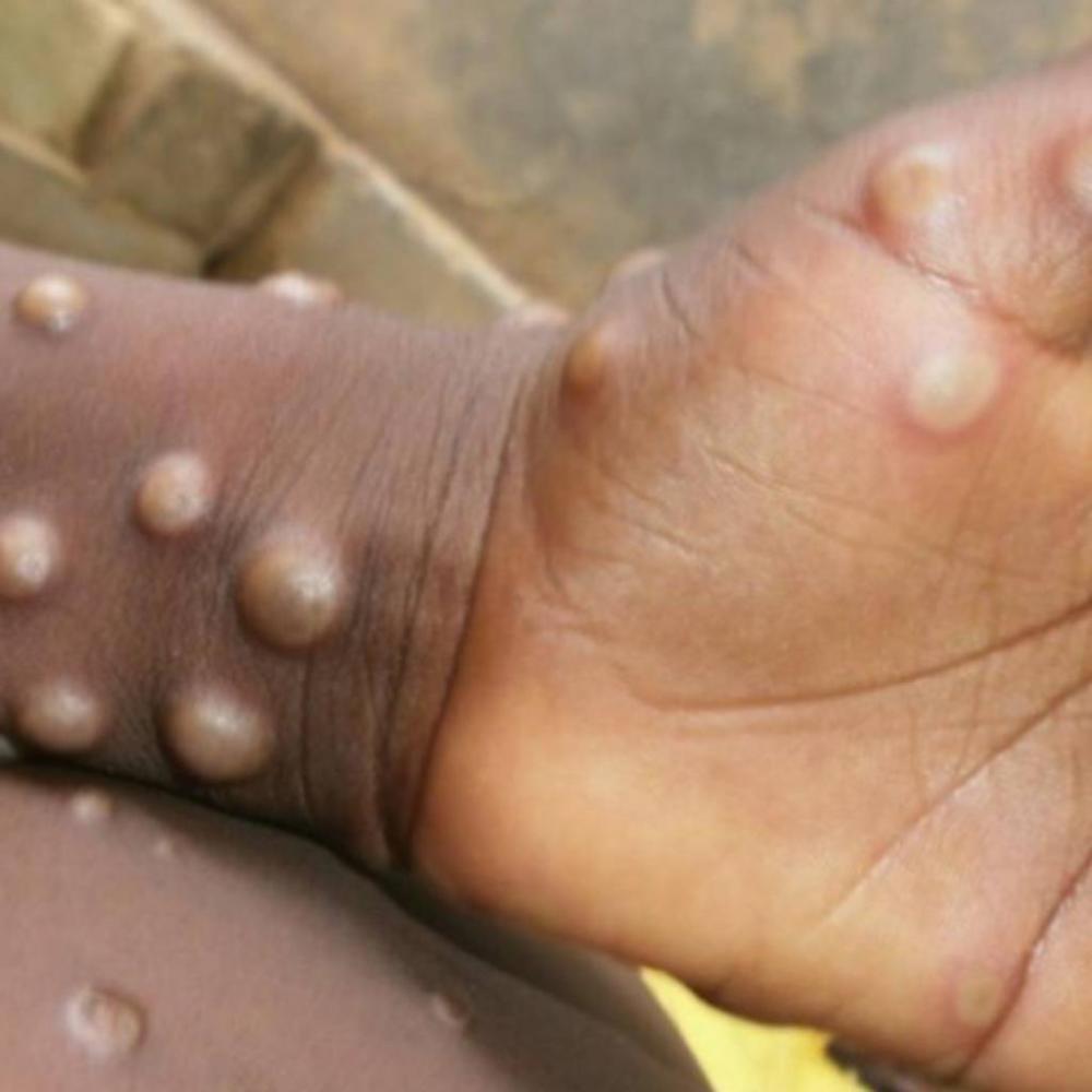 Sobe para 7 número de casos confirmados de variola dos macacos no Piauí