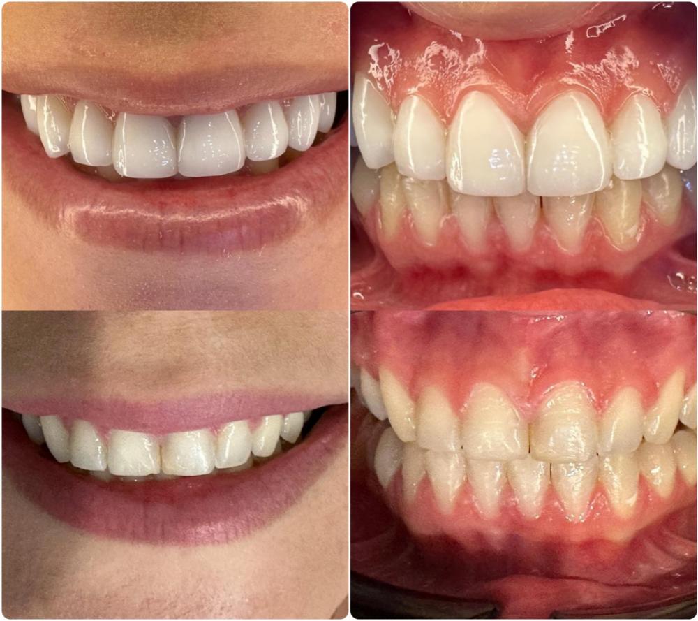 Ortodoc Odontologia é referência em tratamentos com lentes em resina composta! 