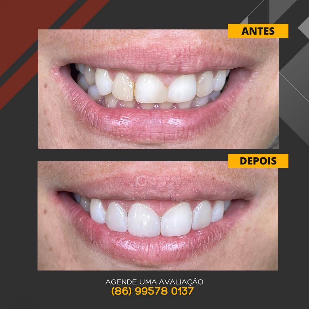 Renove seu sorriso com os tratamentos odontológicos de qualidade da Clínica Vittalis!