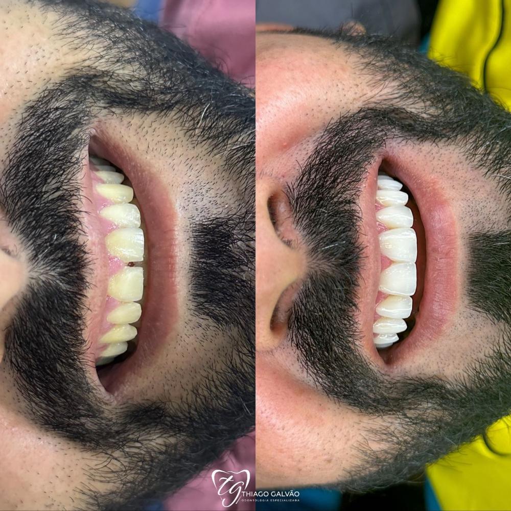 Tenha um sorriso perfeito com as lentes de resina composta da Ortodoc!