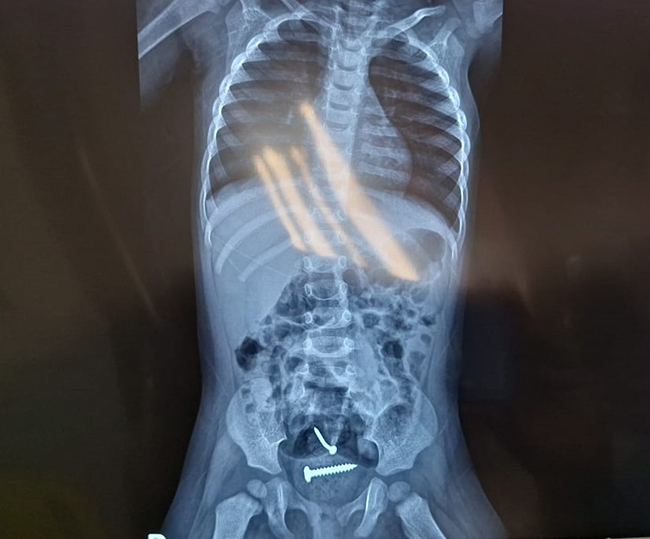 Laudo médico aponta que bebê de 1 ano não sofreu estupro, diz polícia