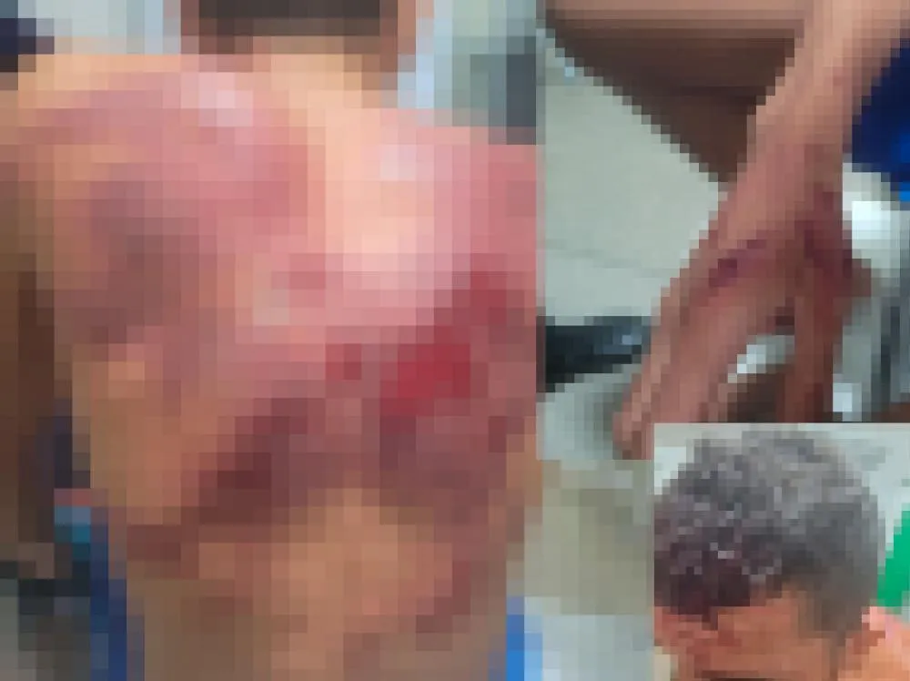 Homem fica gravemente ferido após ter casa invadida e ser brutalmente agredido em Pedro II