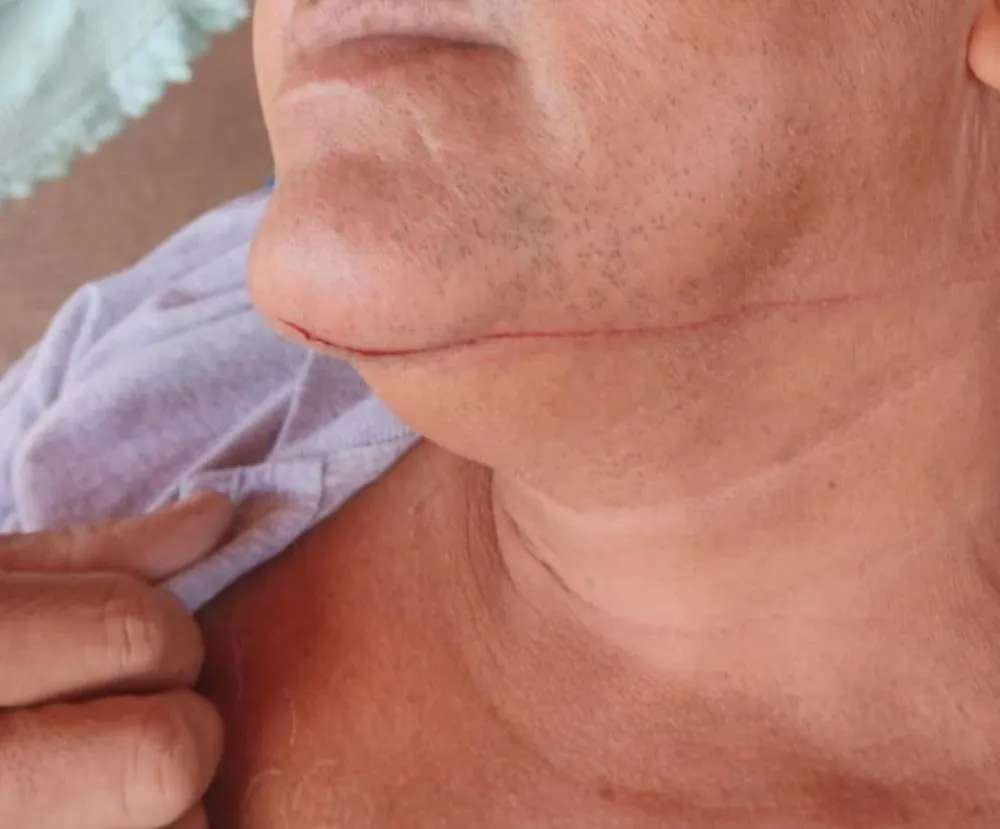 Motociclista sofre ferimento no pescoço após ser atingido por linha de pipa em Pedro II