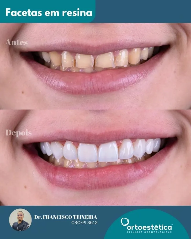 Conquiste o sorriso dos seus sonhos com as facetas da Clínica Ortoestética de Pedro II!