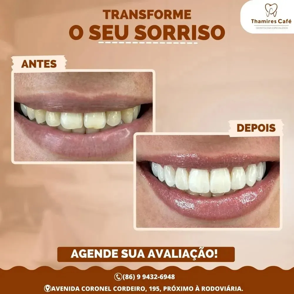 Volte a sorrir com os tratamentos odontológicos da Clínica Thamires Café em Pedro II!