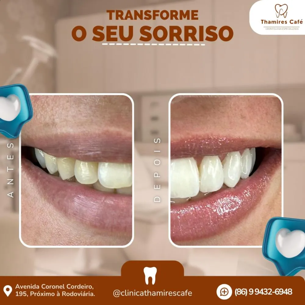 Conquiste um sorriso lindo e saudável com os tratamentos odontológicos da Clínica Thamires Café em Pedro II!1