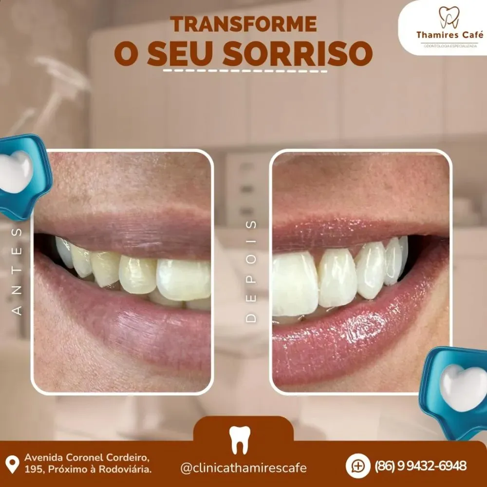 Transforme seu Sorriso na Clínica Thamires Café em Pedro II!