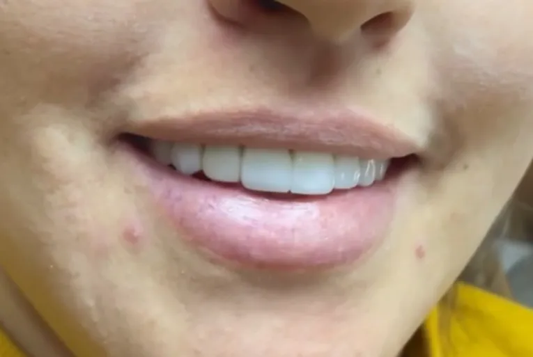 Valorize a beleza do seu sorriso com as facetas em resina composta da Ortoestética de Pedro II!