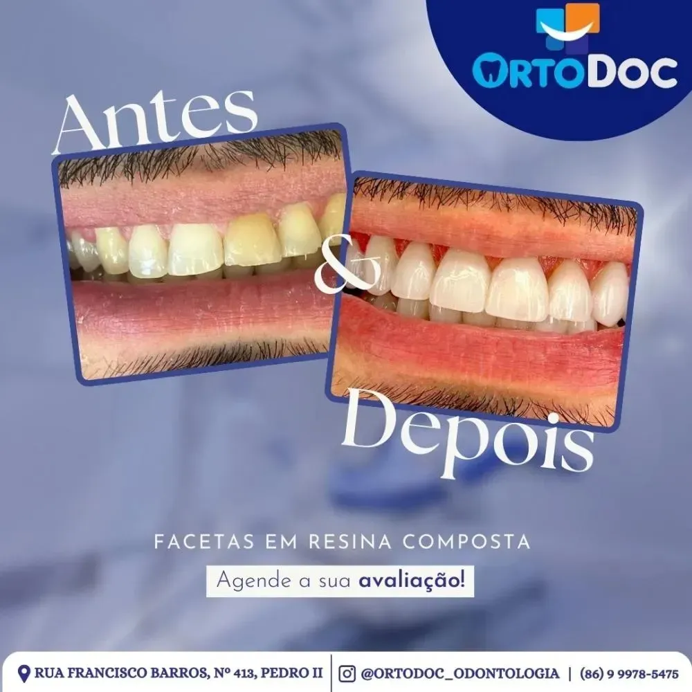 Conquiste um sorriso perfeito com as facetas em resina composta da Ortodoc de Pedro II!