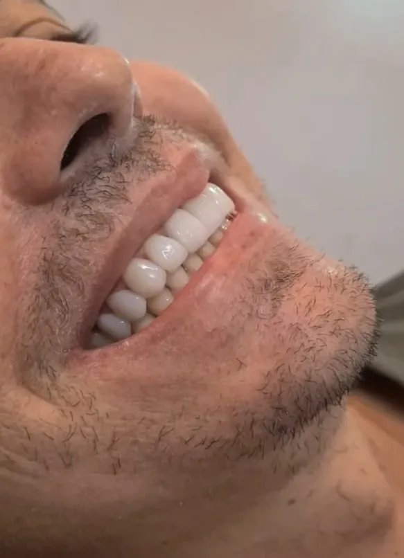 Recupere seu sorriso com as facetas em resina composta da Ortoestética de Pedro II!