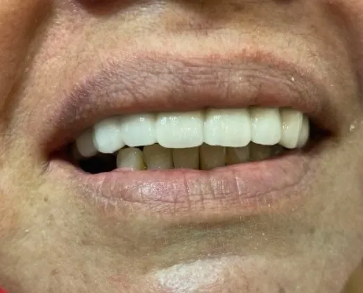 Restaure seu sorriso com a ponte fixa da Ortoestética de Pedro II