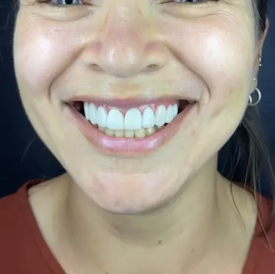 Recupere a beleza do seu sorriso com as facetas em resina da Ortoestética!