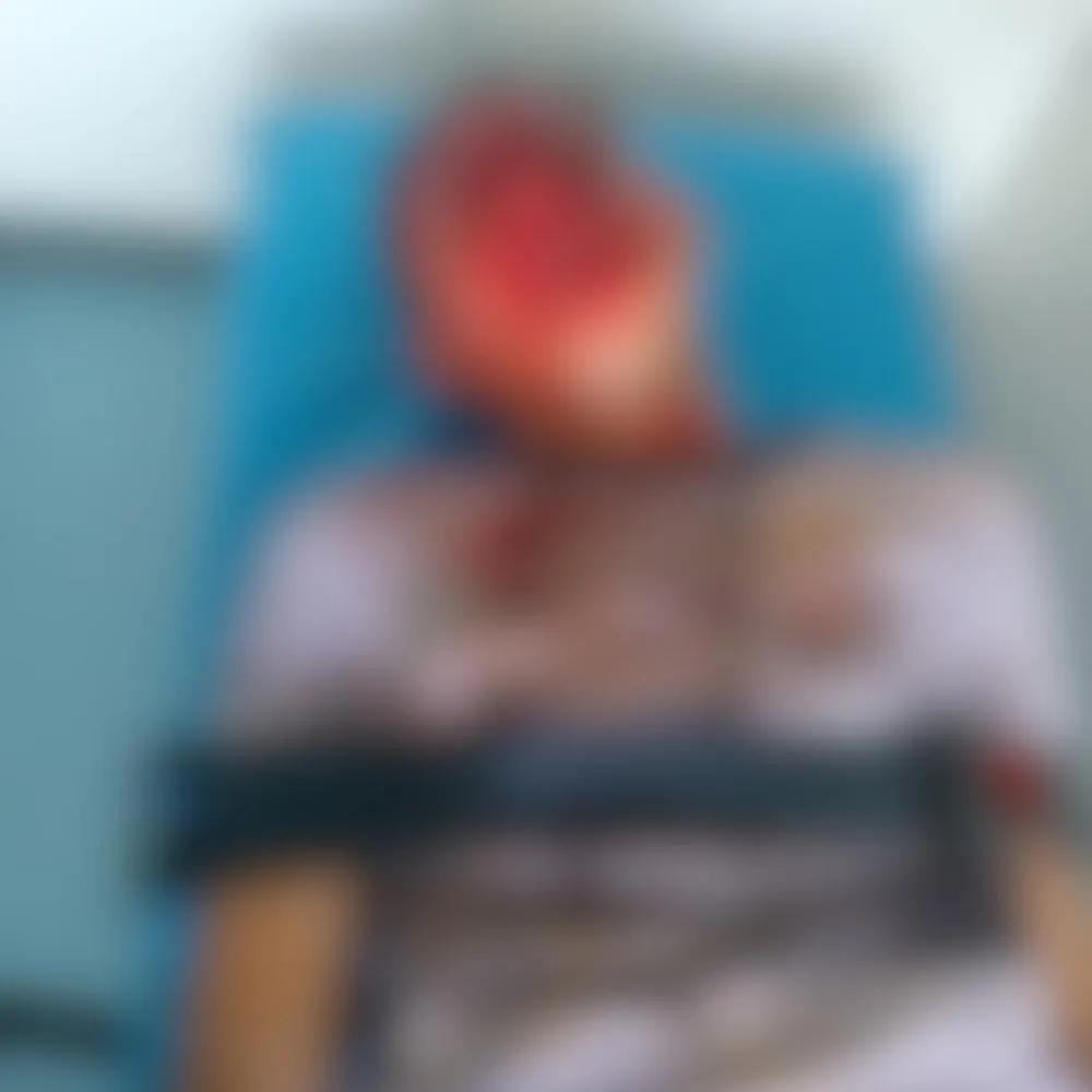 Adolescente fica gravemente ferido após acidente de moto em Milton Brandão